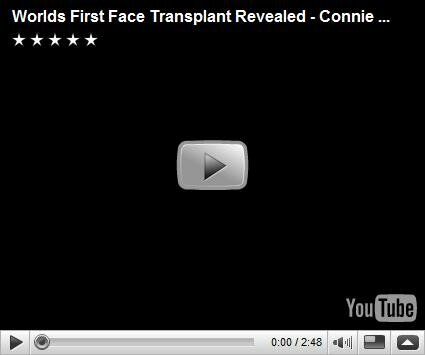 Worlds first face transplant revealed video6b33058d411c Worlds first face transplant revealed